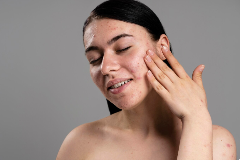 harmonal acne tips siyona raina